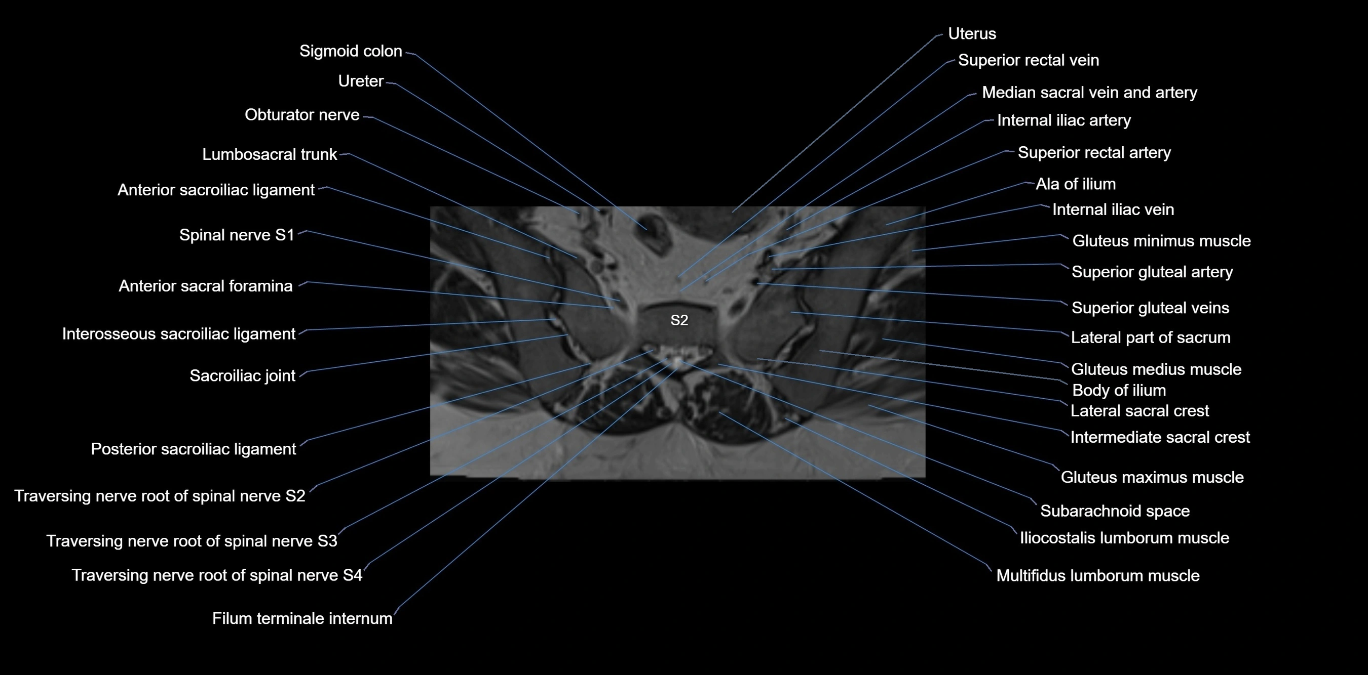 MRI sacrum, coccyx and sacroiliac joint axial cross sectional anatomy 3T  radiology  image-img-00001-00023.webp